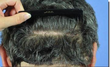 Hair restoration procedure results