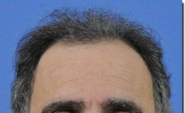 Hair restoration procedure results