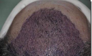 Hair restoration procedure results