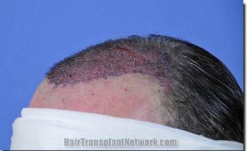 Hair restoration procedure results