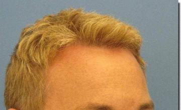 Hair restoration procedure results