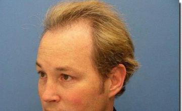 Hair restoration procedure results