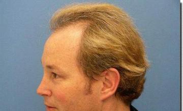 Hair restoration procedure results