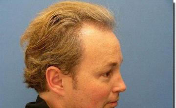 Hair restoration procedure results