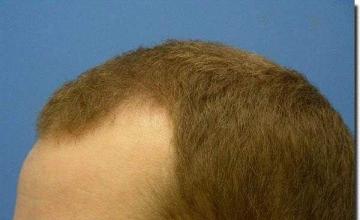 Hair restoration procedure results