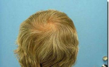 Hair restoration procedure results