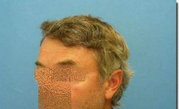 Hair restoration procedure results