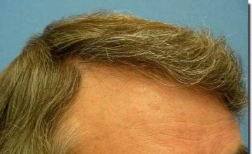 Hair restoration procedure results