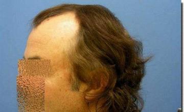 Hair restoration procedure results