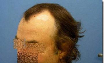 Hair restoration procedure results