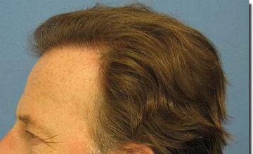 Hair restoration procedure results