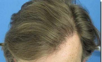 Hair restoration procedure results