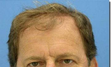 Hair restoration procedure results