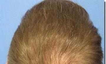 Hair restoration procedure results