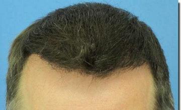 Hair restoration procedure results