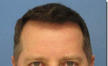 Hair restoration procedure results