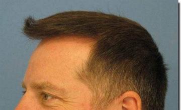 Hair restoration procedure results