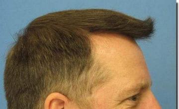 Hair restoration procedure results