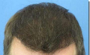 Hair restoration procedure results