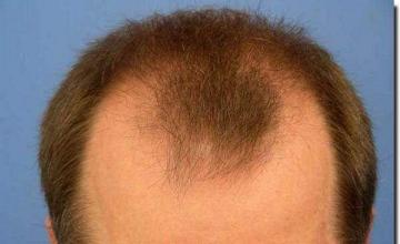 Hair restoration procedure results