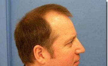 Hair restoration procedure results