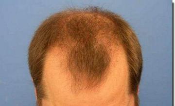 Hair restoration procedure results