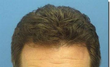 Hair restoration procedure results