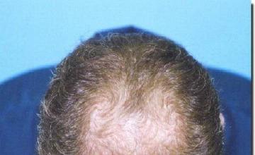 Hair restoration procedure results