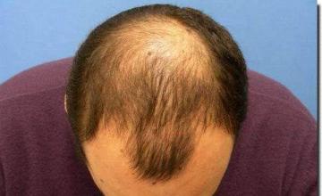 Hair restoration procedure results