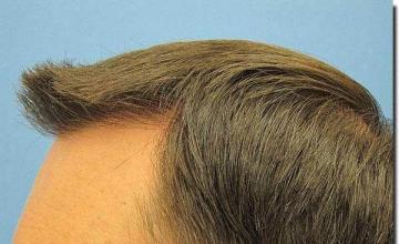 Hair restoration procedure results