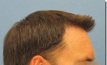 Hair restoration procedure results