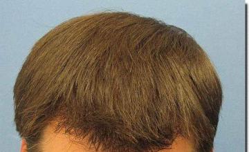 Hair restoration procedure results