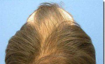 Hair restoration procedure results