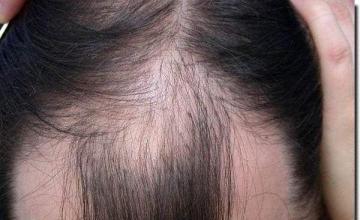 Hair restoration procedure results