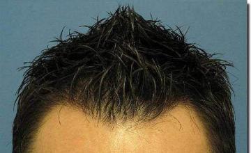 Hair restoration procedure results