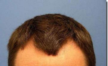 Hair restoration procedure results