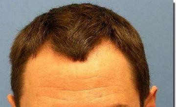 Hair restoration procedure results