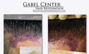 Hair restoration surgery before and after photos