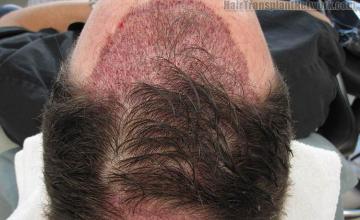 Hair restoration surgery before and after images