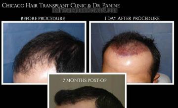 Hair transplantation surgery before and after pictures