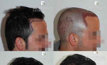 Hair transplantation surgery before and after photos