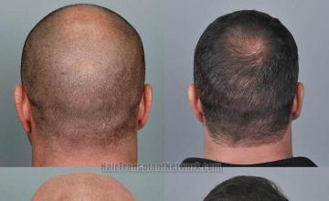 Hair restoration procedure before and after pictures