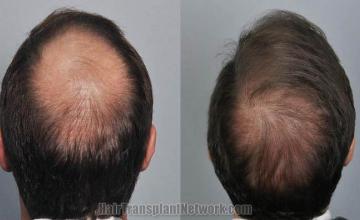 Hair transplantation surgery before and after images