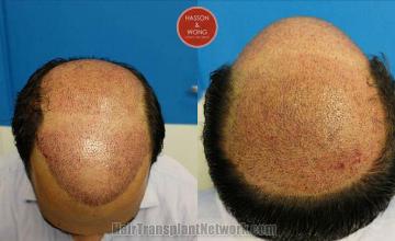 Hair restoration surgery before and after photos