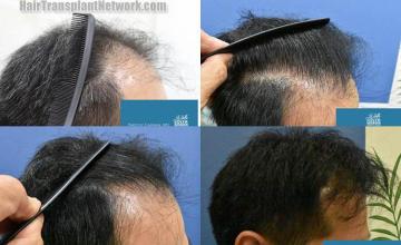 Hair restoration procedure before and after results