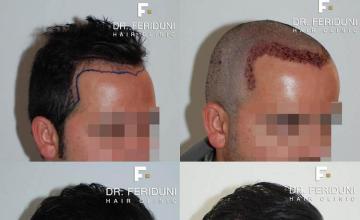 Hair restoration procedure before and after pictures