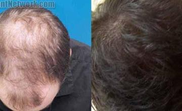 Hair transplantation surgery before and after images