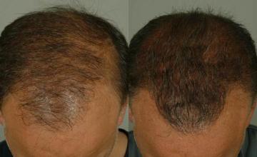 Top view - Before and after surgical hair replacement