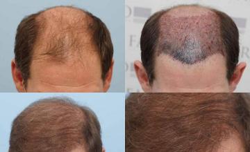 Top view before and after hair restoration results