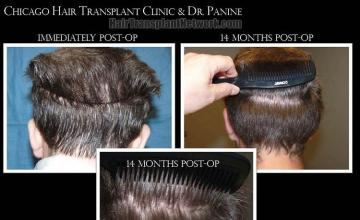 Hair restoration surgery before and after photos